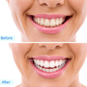 before and after picture of yellow teeth versus white teeth