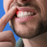 Example of periodontal gum disease